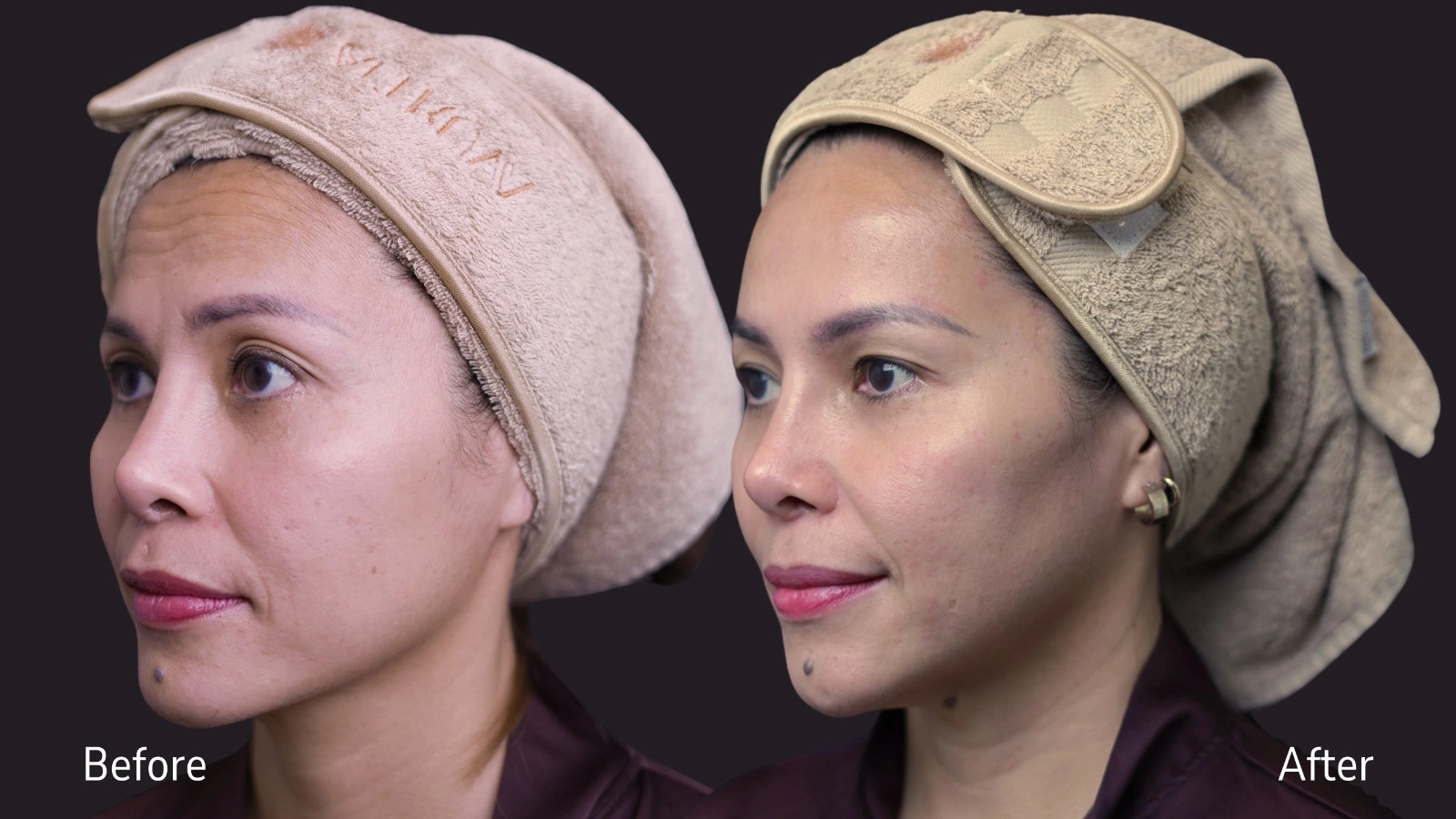 Before and after treatment
